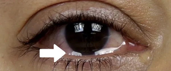 Ojos con brillo adicional sobre el párpado inferior